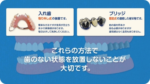 ブリッジと入れ歯の違い